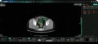 Damo Academy said its Coca AI model has higher sensitivity in detecting colorectal cancer than radiologists. Photo: Handout