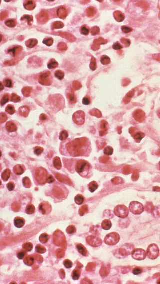 A micrographic study of liver tissue seen from a hantavirus pulmonary syndrome (HPS) patient seen in this undated photo obtained by Reuters, July 6, 2017