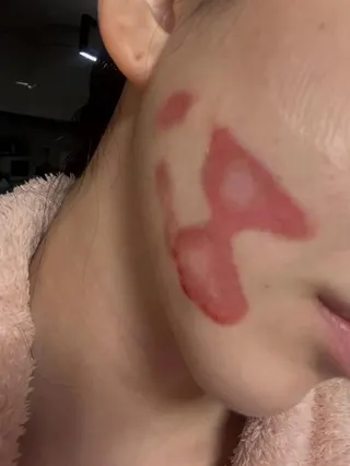 珉娥1月底做醫美皮膚卻被燒傷，險些毀容。翻攝IG@new.kma