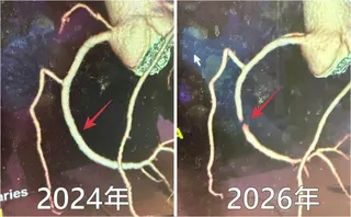 林男接受心臟血管攝影檢查，赫然發現短短2年，右冠狀動脈從整條通暢（左），變成嚴重...
