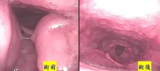 新竹馬偕醫院指出，手術前可見患者左右兩側顎咽扁桃腺及舌根扁桃腫大，造成呼吸道阻塞...