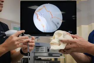 Ottolaryngologist Tan Jian Li demonstrating where the endoscope is inserted into a model skull to remove the tumour through the eye socket.