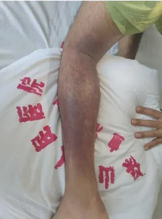 阿傑的左腿脹發紫發黑。（取材自春城晚報）