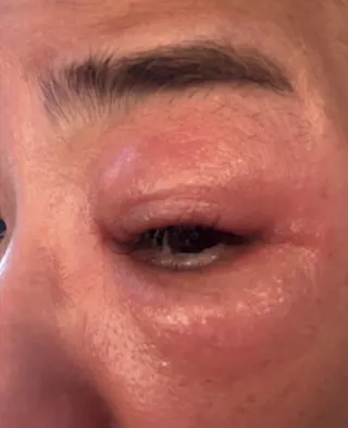 眼睛疑似因接觸隱翅蟲而受到刺激感染，腫脹情況相當明顯。（圖／翻攝自裘海正FB）