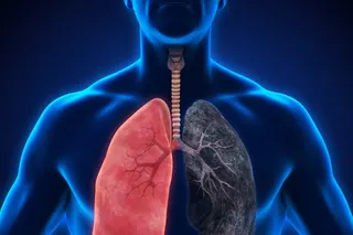 Illustration of a healthy lung and a smoker's lung. Photo: Shutterstock
