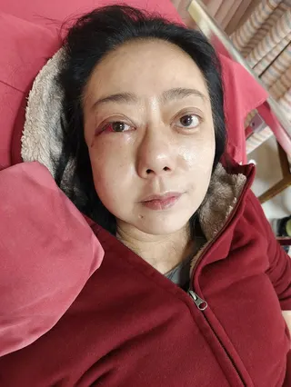 高慧君去年底無預警昏倒，造成臉部骨折。經紀人提供