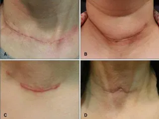 甲狀腺傳統手術容易戴上「拿不掉的項鍊」。（嘉義基督教醫院提供）