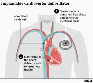 BBC infographic for an implantable cardioverter defibrillator (ICD) showing a simplified human torso with the heart and major veins. A small implanted device sits in the chest with a wire running through a vein into the heart. Labels explain that a sensor detects an abnormal heartbeat and generates an electrical pulse, and then electrodes in the heart deliver a shock to reset heart rhythm.