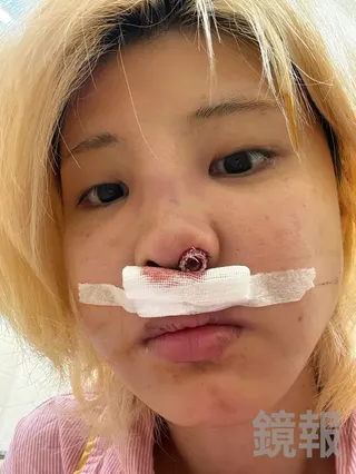 苡琍Hana日前動手術取出鼻子裡的非法植入物。當事人提供