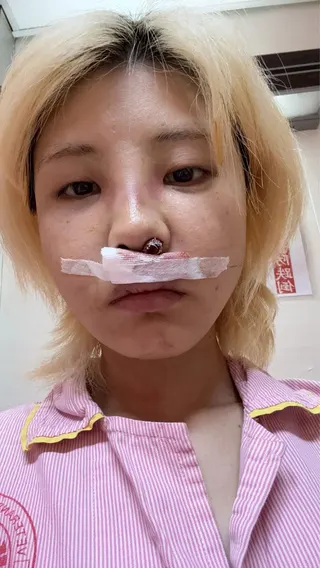 苡琍Hana控訴閨密沈琪琪介紹的醫美診所，竟在她的鼻頭埋了不合法的線材。（翻攝自臉書苡琍 - Hana﻿ ）