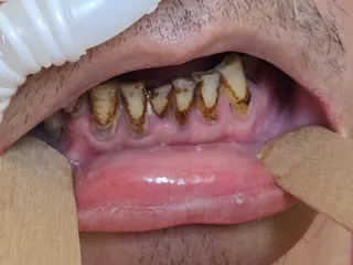 李男有嚼食檳榔、牙周病。（烏日林新醫院提供）