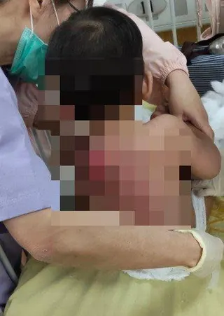 男童被診斷為全身超過25%的深二度至三度燒燙傷。（圖／李小姐授權提供）