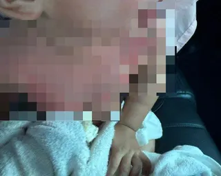 1歲半男童嚴重燒燙傷緊急送醫。（圖／李小姐授權提供）